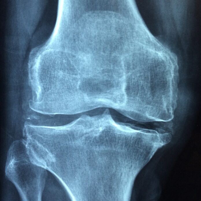 Рентген, снимок, коленный сустав